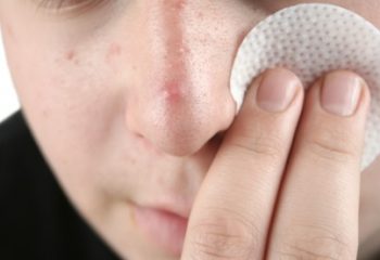 A man wiping his acne with a facial pad